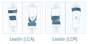 Rodillera neopreno ligamentos cruzados Aplicación de la rodillera en lesiones del LCA y LCP